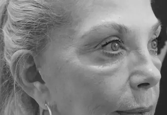 A Revere Clinics patient photographed in profile